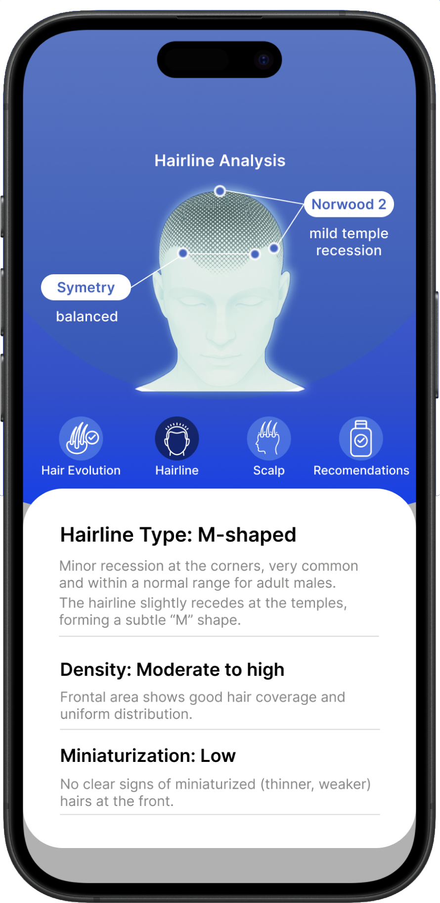 HairBuddy analysis screen showing hairline insights